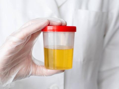 leucociti nelle urine